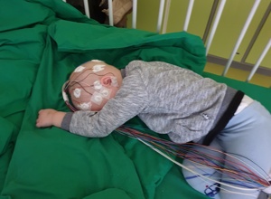 EEG für SYNGAP1-Kinder