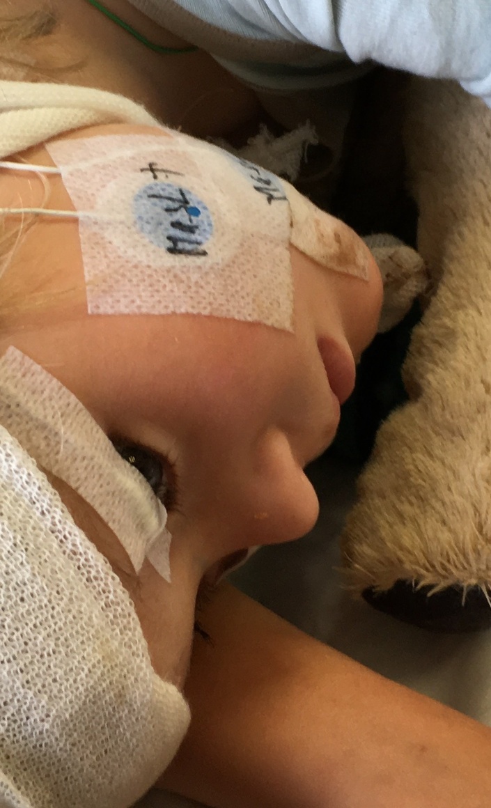 EEG für SYNGAP1-Kinder